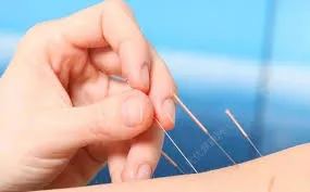 Jk kinesisk medicin, akupunktur, zonterapi